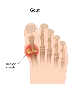 Gelenkschmerzen durch Arthrose - Bild: © Alila Medical Media - Fotolia.com